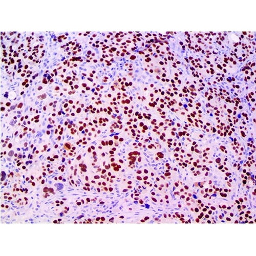 PAX-8 Antibody Immunohistochemistry on a FFPE Ovarian Carcinoma Tissue